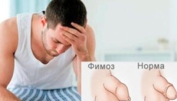 фимоз Что такое фимоз у мужчин